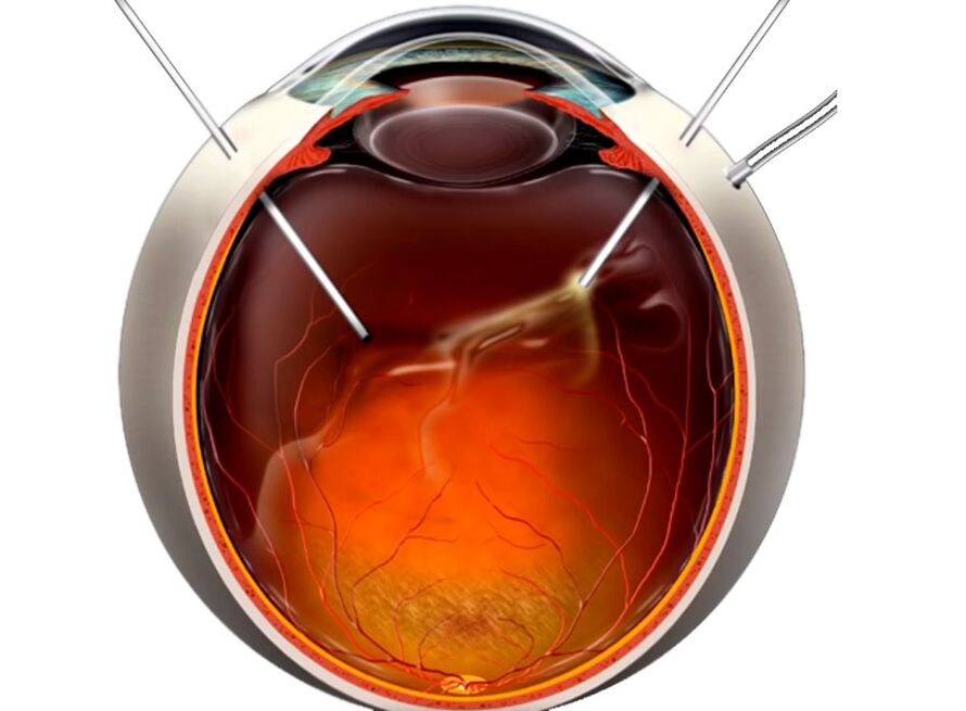 Vitrectomía un procedemento que se mostra ás persoas cando a exfoliación da retina